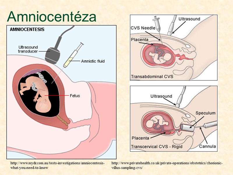 Amniocentéza http://www.mydr.com.au/tests-investigations/amniocentesis-what-you-need-to-know http://www.privatehealth.co.uk/private-operations/obstetrics/chorionic-villus-sampling-cvs/